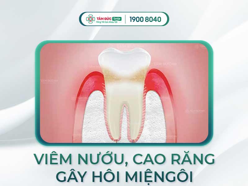 NƯỚC BỌT CÓ MÙI HÔI LÀ DẤU HIỆU CỦA BỆNH GÌ?