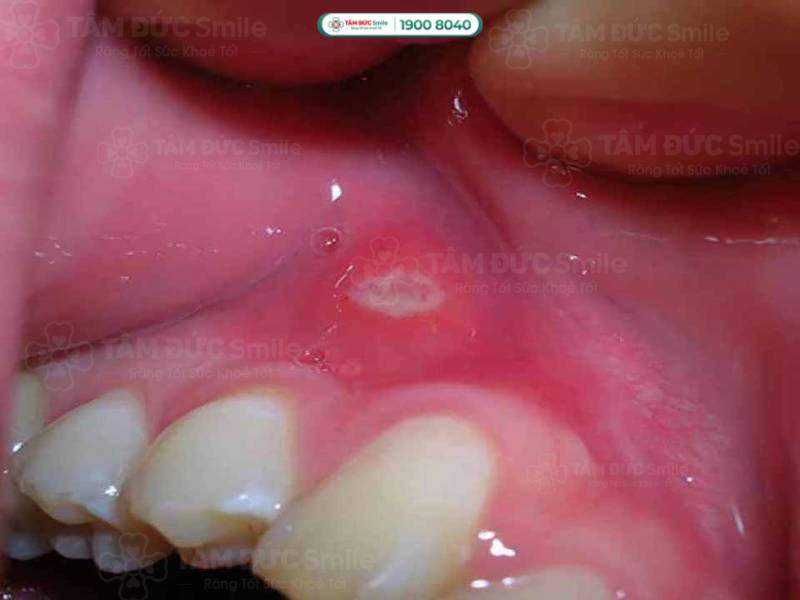 nướu răng bị sưng có phải dấu hiệu nguy hiểm không