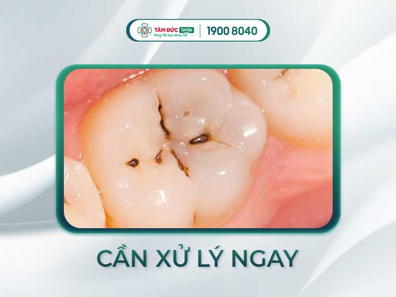 PHẢI LÀM GÌ KHI KẼ RĂNG HÀM BỊ ĐEN? CÁCH ĐIỀU TRỊ VÀ PHÒNG NGỪA LÂU DÀI