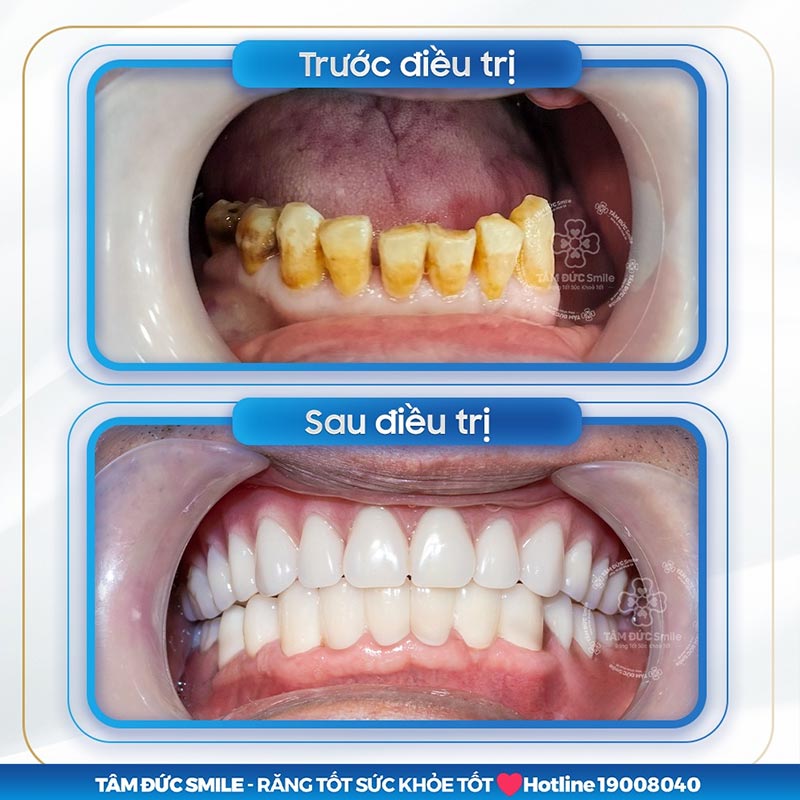 TOP 3 PHƯƠNG PHÁP TRỒNG RĂNG HÀM BỊ SÂU AN TOÀN, HIỆU QUẢ