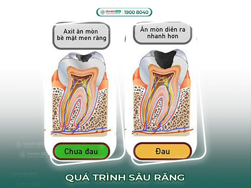 QUÁ TRÌNH SÂU RĂNG DIỄN RA NHƯ THẾ NÀO?