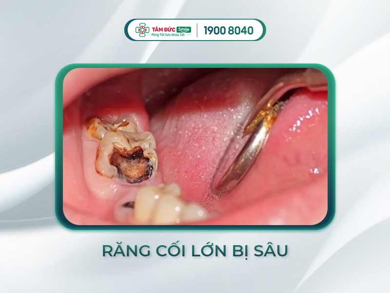 RĂNG CỐI BỊ SÂU: NGUYÊN NHÂN, TRIỆU CHỨNG VÀ CÁCH ĐIỀU TRỊ HIỆU QUẢ