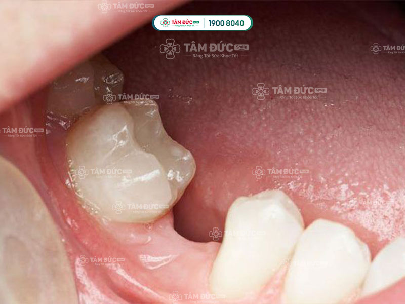 răng cối sữa ở trẻ đã rụng