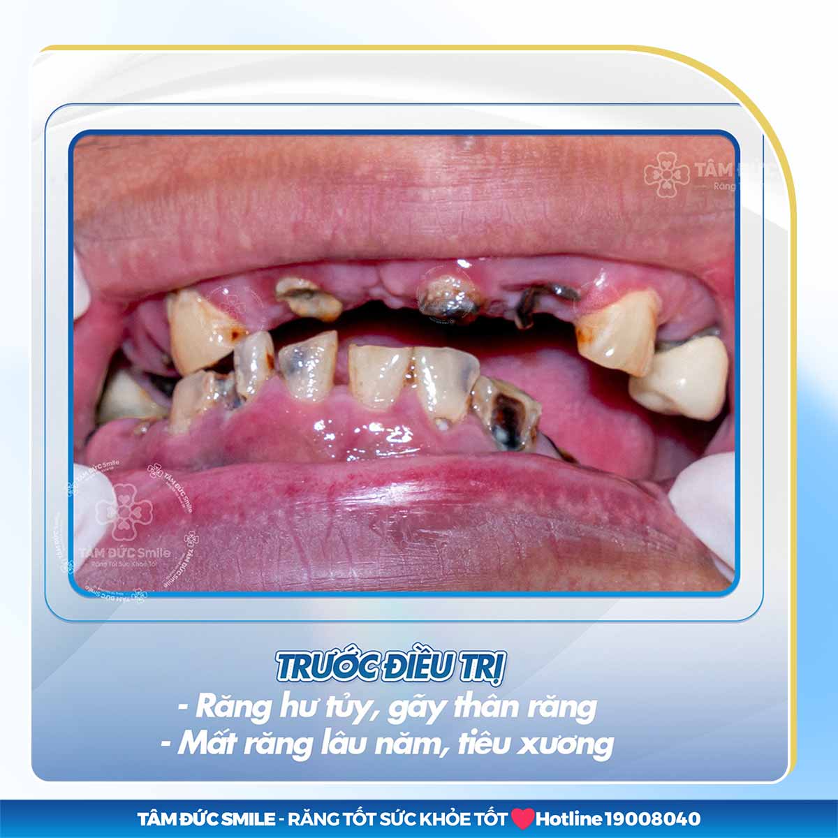 [GIẢI ĐÁP] RĂNG GÃY CÓ TRỒNG LẠI ĐƯỢC KHÔNG? PHƯƠNG PHÁP TRỒNG RĂNG AN TOÀN HIỆN NAY