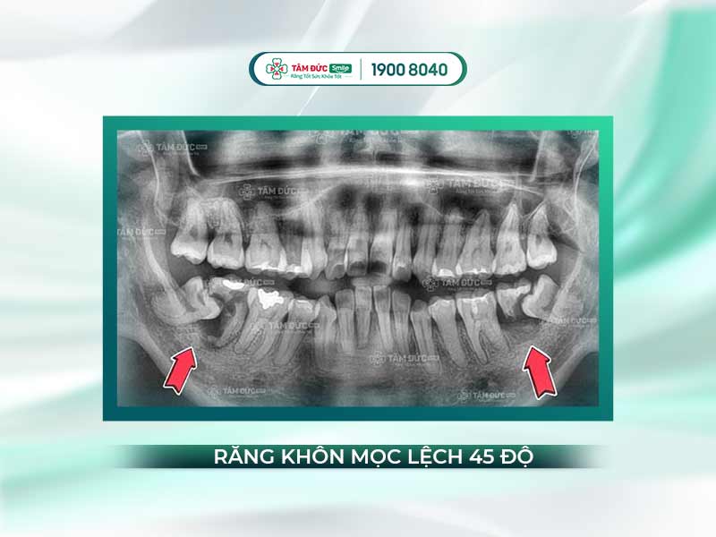 RĂNG KHÔN MỌC LỆCH 45 ĐỘ CÓ NÊN NHỔ KHÔNG?