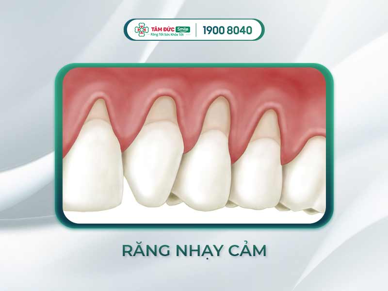 NGUYÊN NHÂN RĂNG BỊ NHẠY CẢM VÀ PHƯƠNG PHÁP ĐIỀU TRỊ DỨT ĐIỂM