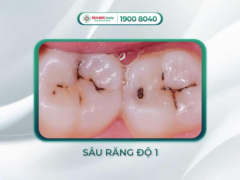 RĂNG SÂU ĐỘ 1 LÀ NHƯ THẾ NÀO? – GIẢI PHÁP KHẮC PHỤC SÂU RĂNG MỨC ĐỘ NHẸ