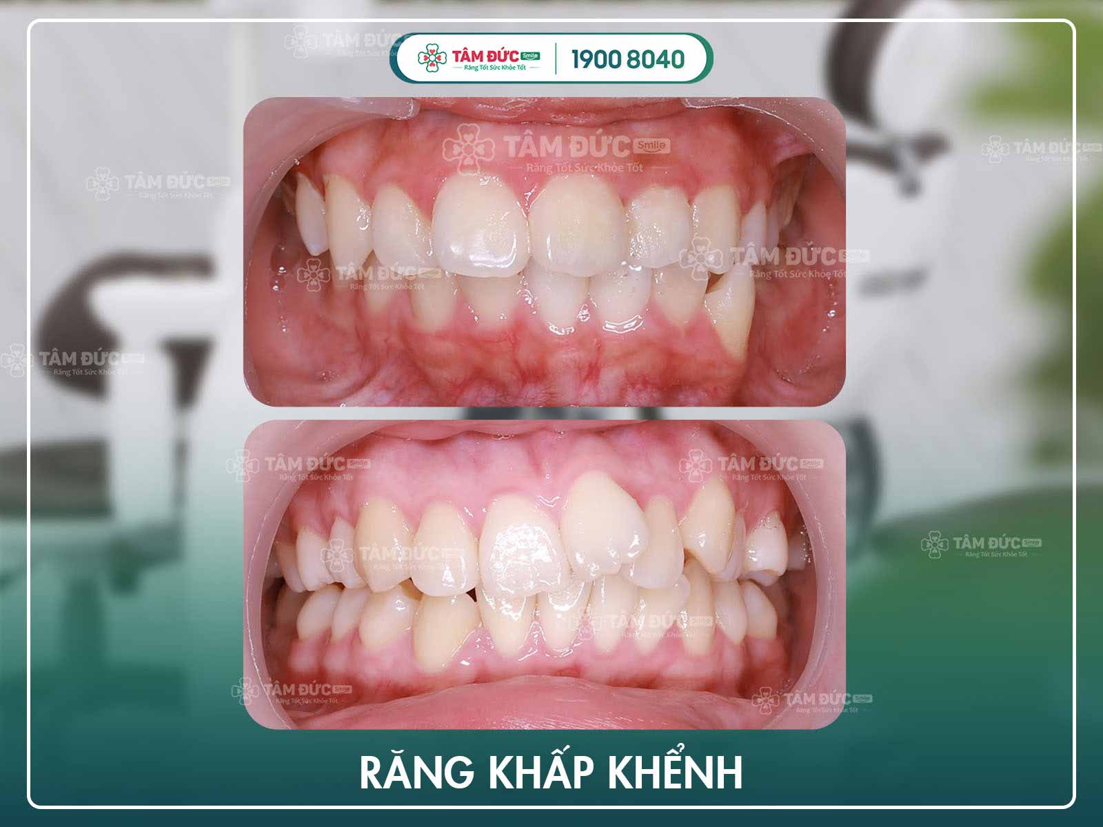 hình ảnh răng khấp khểnh