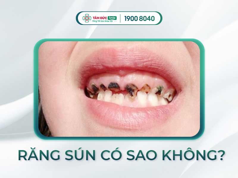 RĂNG SÚN CÓ MỌC LẠI ĐƯỢC KHÔNG? NÊN LÀM GÌ KHI TRẺ BỊ SÚN RĂNG