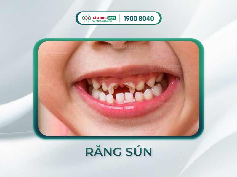 RĂNG SÚN LÀ GÌ? TRẺ BỊ SÚN RĂNG CÓ ẢNH HƯỞNG GÌ KHÔNG?