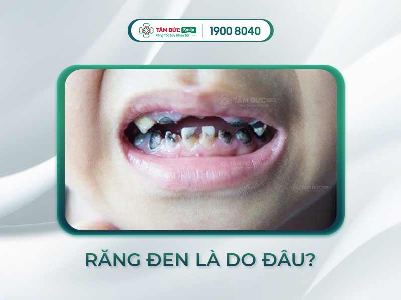 RĂNG TRẺ BỊ ĐEN: NGUYÊN NHÂN TỪ ĐÂU? KHẮC PHỤC NHƯ THẾ NÀO?