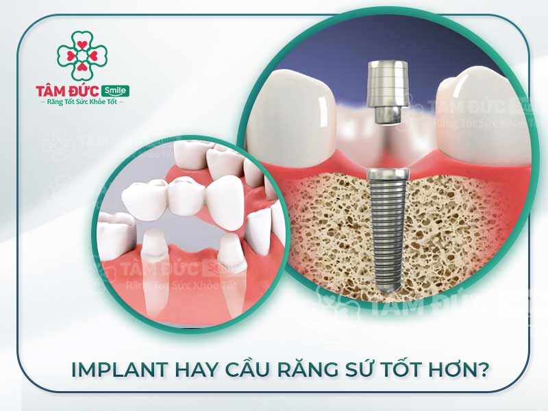 SO SÁNH IMPLANT VỚI CẦU RĂNG SỨ: NÊN CHỌN GIẢI PHÁP NÀO?