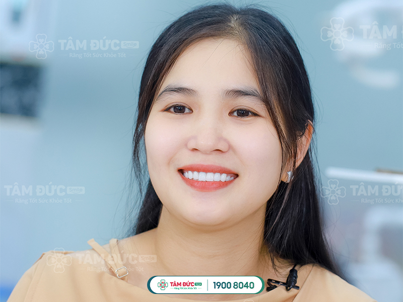 SO SÁNH RĂNG TOÀN SỨ ZIRCOMAX VÀ CERCON HT LOẠI NÀO TỐT HƠN?