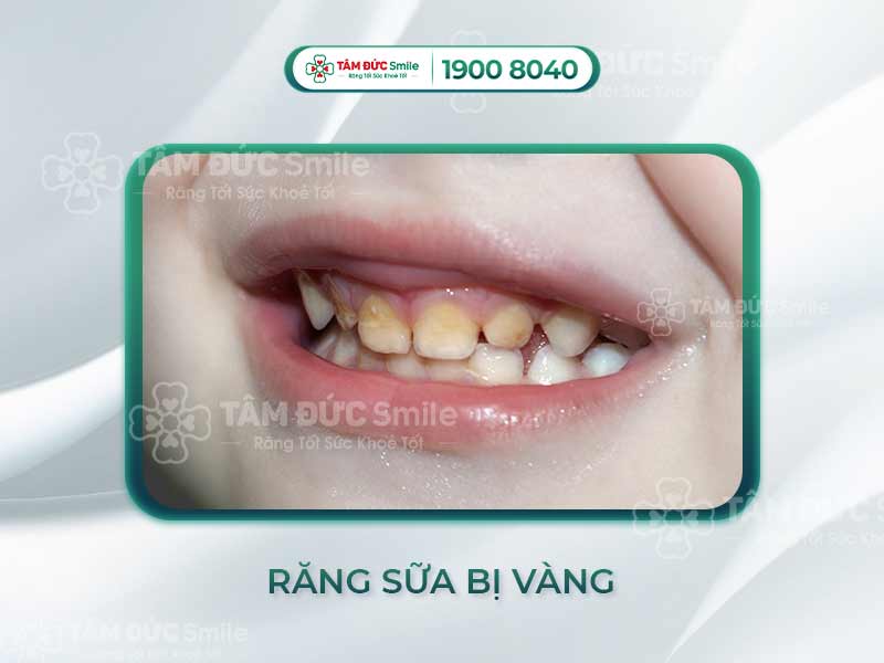TẠI SAO TRẺ BỊ VÀNG RĂNG SỮA? CÁCH ĐIỀU TRỊ AN TOÀN CHO TRẺ