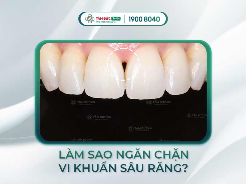 TAM GIÁC ĐEN Ở RĂNG LÀ GÌ? NGUYÊN NHÂN VÀ CÁCH KHẮC PHỤC