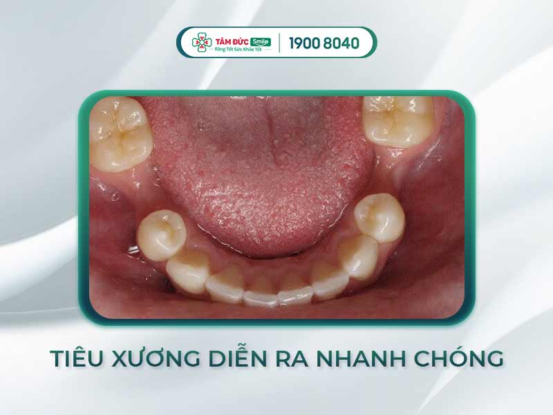 BỊ TIÊU XƯƠNG RĂNG: BIỂU HIỆN, BIẾN CHỨNG VÀ CÁCH PHÒNG NGỪA