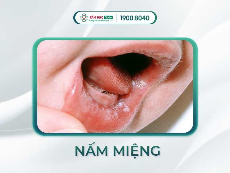 TRẺ EM BỊ NẤM MIỆNG CÓ NGUY HIỂM KHÔNG? NGUYÊN NHÂN VÀ CÁCH TRỊ