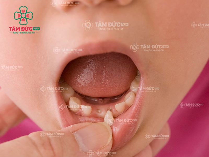 răng lung lay bao lâu thì rụng