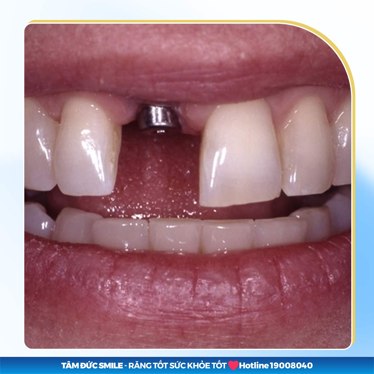 TRỒNG LẠI RĂNG CỬA HÀM TRÊN BAO NHIÊU TIỀN? BẢNG GIÁ TẠI NHA KHOA TÂM ĐỨC SMILE