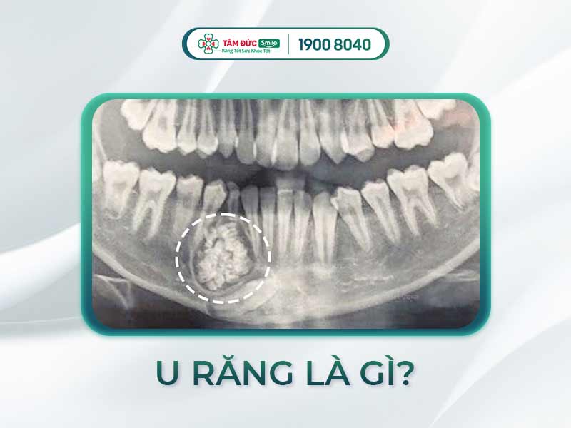 U RĂNG CÓ NGUY HIỂM KHÔNG? ĐIỀU TRỊ CÓ ĐAU KHÔNG?