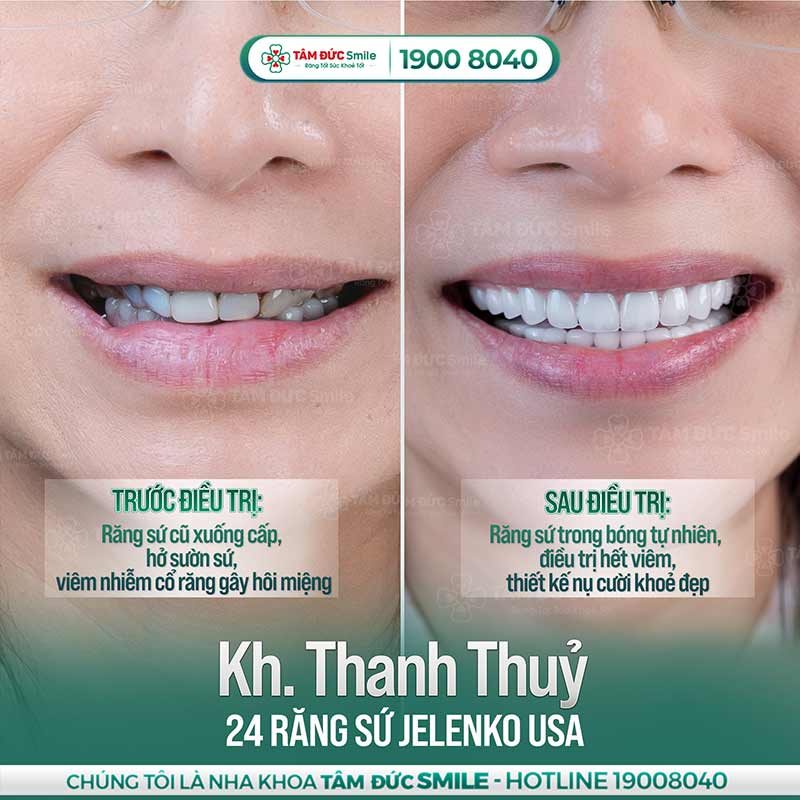 uống nước đá bị ê răng là do đâu