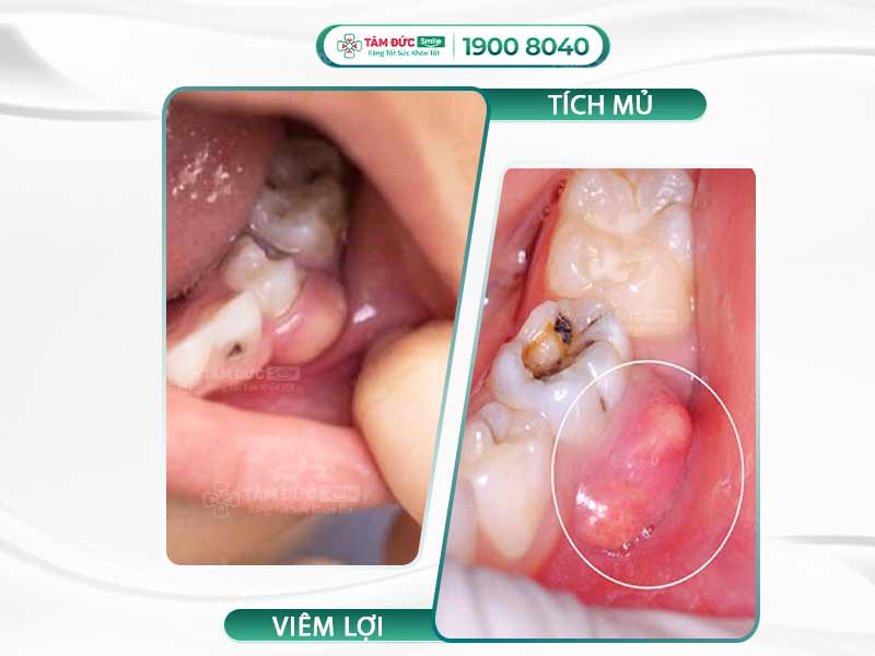 VIÊM LỢI CÓ MỦ LÀ GÌ? NGUYÊN NHÂN VÀ CÁCH ĐIỀU TRỊ 