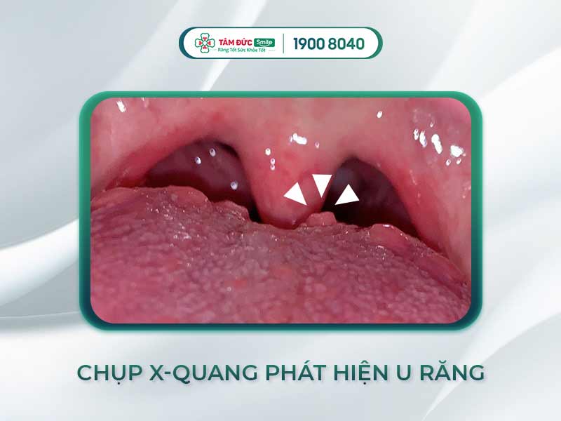 VIÊM LƯỠI HẠT LÀ GÌ? CÓ NGUY HIỂM KHÔNG? BIỆN PHÁP ĐIỀU TRỊ HIỆU QUẢ