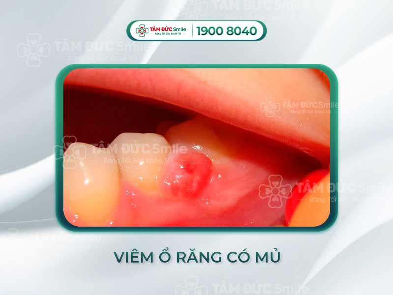 VIÊM Ổ RĂNG CÓ MỦ CÓ NGUY HIỂM KHÔNG? CÁCH CHỮA TRỊ VÀ PHÒNG TRÁNH HIỆU QUẢ